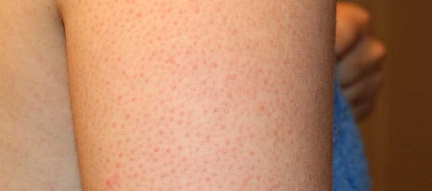 The Reason People Get Chicken Skin And The Best Way To Treat It Newegy