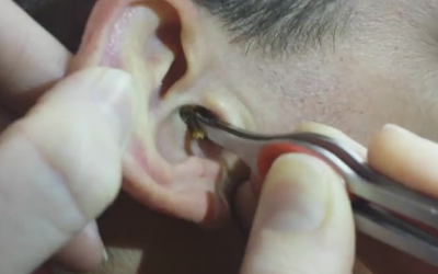 Man Helps His Friend With His Ear Issue.
