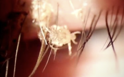 She Thought She Had A Really Bad Eye Infection. But The Truth Is Way More Scary!