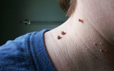 The Easiest Most Natural and Effective Way To Get Rid of Annoying Skin Tags