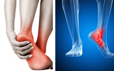 When You Wake Up Does Your Heel Hurt or Anytime You Walk? THIS Is The Reason Why And What To Do.