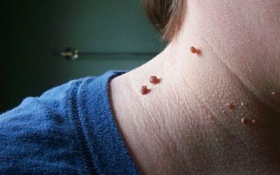 A Simple Way To Remove Irritating Skin Tags.