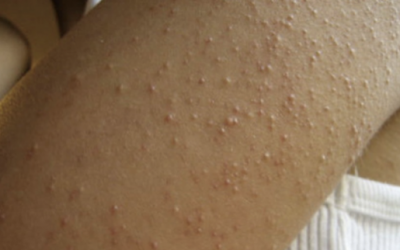 9 Signs and Symptoms That You Have a Gluten Allergy and Don’t Even Know It. I Had No Idea.