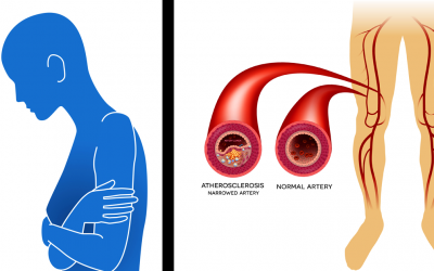 8 Signs and Symptoms You Have Poor Circulation and Peripheral Artery Disease, and Don’t Know It.