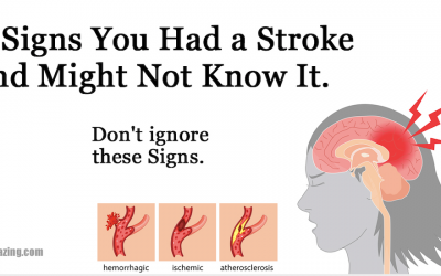 8 Signs You Had a Stroke and Might Not Know It. Don’t Ignore These Signs.