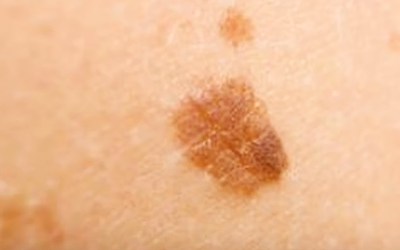 A Simple Way To Naturally Get Rid Of Those Unsightly Brown Spots For Good.