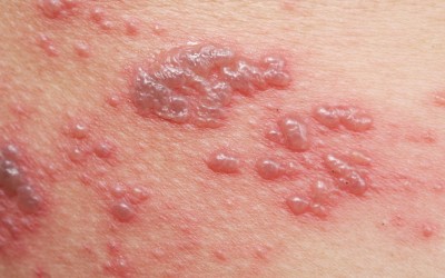 This Is What Shingles Actually Are and Here Is The Simplest Way To Naturally Treat It at Home