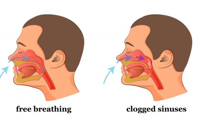 A Simple Life Hack To Clear a Stuffed Nose and Clogged Sinus In Seconds During The Polar Vortex 2019