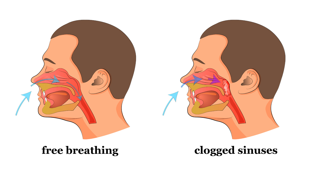 Do You Have a Stuffed Nose Or Clogged Sinuses? This Simple
