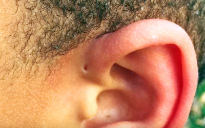 Have You Ever Noticed This Tiny Hole Above Someone’s Ear? This Is The Strange Reason Why It’s There.