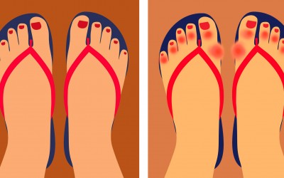 6 Reasons Doctors Are Now Warning People To Never Wear Flip Flops Again.