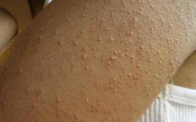 7 Signs and Symptoms You Have a Gluten Intolerance and May Not Even Realize It.