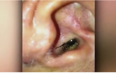 VIDEO: This Guy Felt A Serious Itch In His Ear. So He Grabbed A Camera and Caught THIS Popping Out