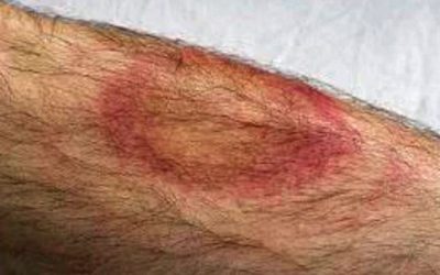 This Man Died Days After This Red Spot Showed Up. When The Docs Figured Out Why They Freaked!