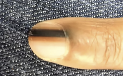 If You Notice A Black Line On Your Nail Or Someone Else’s It Means THIS