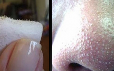 THIS One Easy Trick Can Get Rid Of All Those Annoying and Gross Blackheads Instantly!