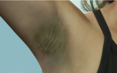 How To Lighten Dark Underarms With A Simple Trick Using Ingredients You Already Have In Your Kitchen!