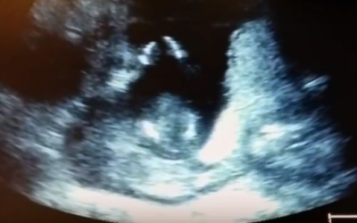 Mom Was Really Nervous Before Her Ultrasound. But What The Doctor Noticed Is Super Rare!