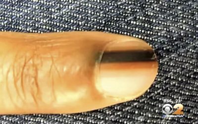 If You See This Black Line On Your Nail Or Someone Else’s THIS Is What It Means!
