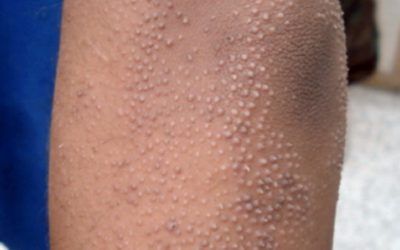 The 8 Most Common Signs Of A Gluten Intolerance Most People Don’t Know They Have Or Just Ignore!