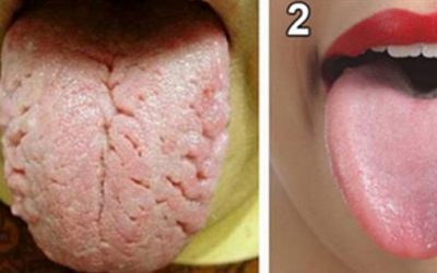What Does Your Tongue Reveal About Your Health? Go To A Mirror And Check Yours Right Now!