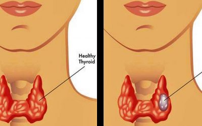 15 Million Americans Are Undiagnosed For Thyroid Disorders. These Are The Symptoms You Can’t Ignore!