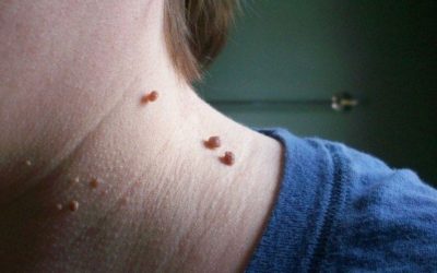 The Simple Way To Treat and Remove Blackheads Age Spots Warts Moles and Skin Tags With No Chemicals!