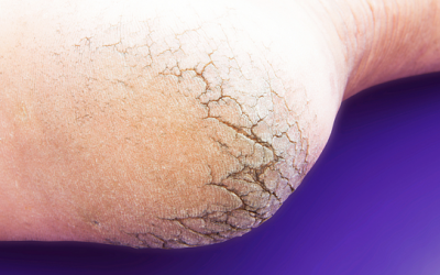 If You Have Dry and Cracked Feet THIS Simple Foot Hack Will Get Rid Of It For Good!