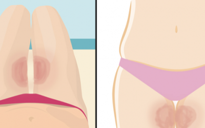 This Simple Life Hack Will To Stop Your Thighs From Getting Chafed This Summer!