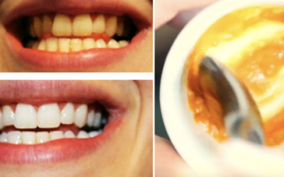 He Mixes This Paste With A Common Household Product That Will Reverse Gum Disease And Whiten Teeth