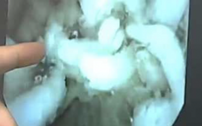 If You Eat Ramen Noodles THIS Is What Happens In Your Body!