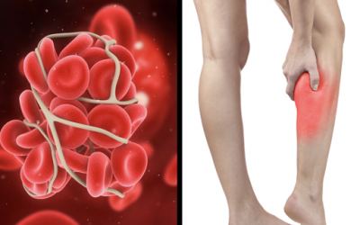 These Are The Symptoms and Signs That You Are Having a Blood Clot. THIS Is What You Need To Do.