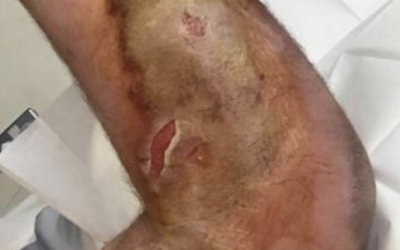This Guy Felt A Bite On His Arm But Didn’t Think Much Of It. He Went To Bed Woke Up and Saw THIS