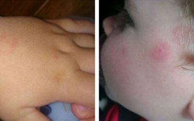 If You See A Spot Like This On Your Child’s Cheek Go To The Hospital ASAP. The Reason Is Terrifying!