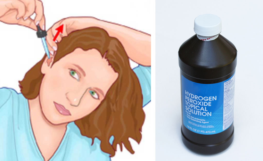 She Drops Hydrogen Peroxide In Her Ears 3x Per Week For a Month. The