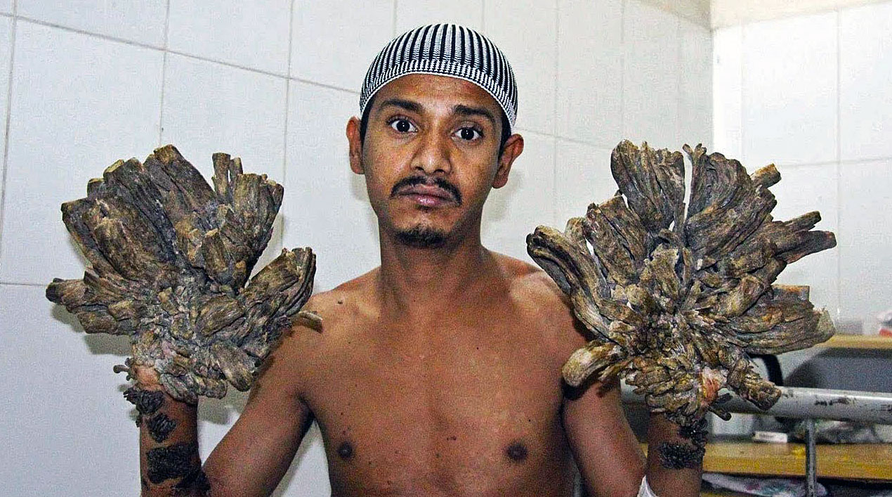 He Had a Rare Disease Called 'Tree Man Syndrome'. The Docs Do Surgery